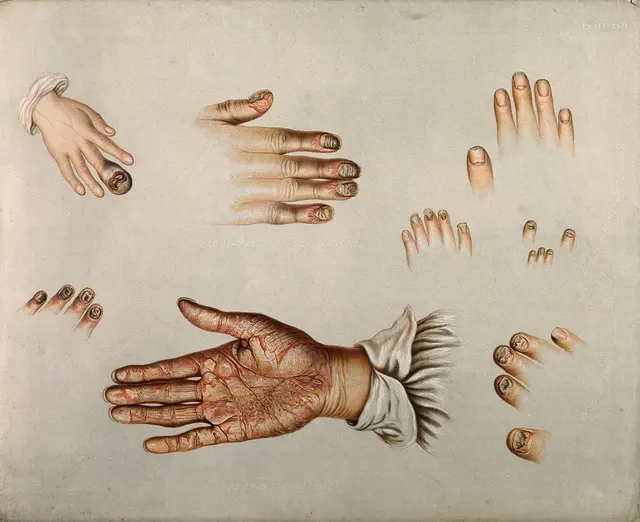 Заболевания кожи и ногтей, 1850-80 Wellcome V0010209.jpg